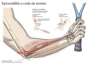 codo_de_tenista_fisioterapeuta_barcelona